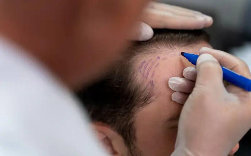 Hair Transplant
