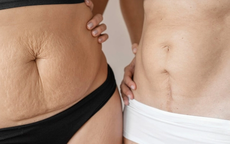 Stretch Mark Treatment